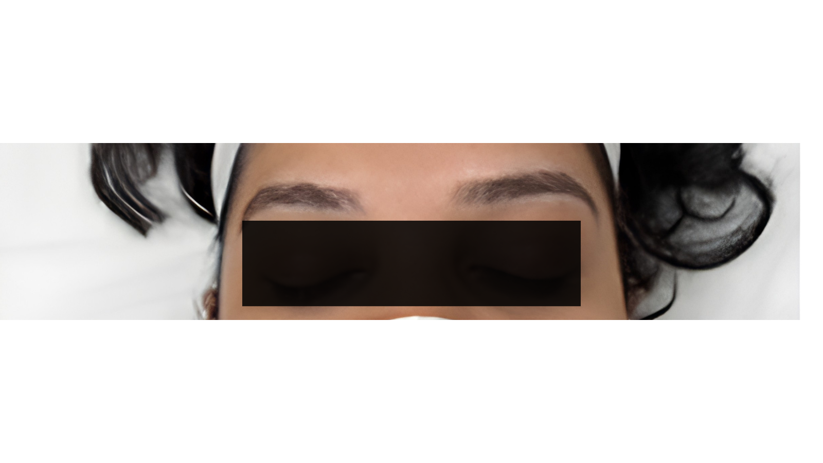 Scalp Micropigmentation before