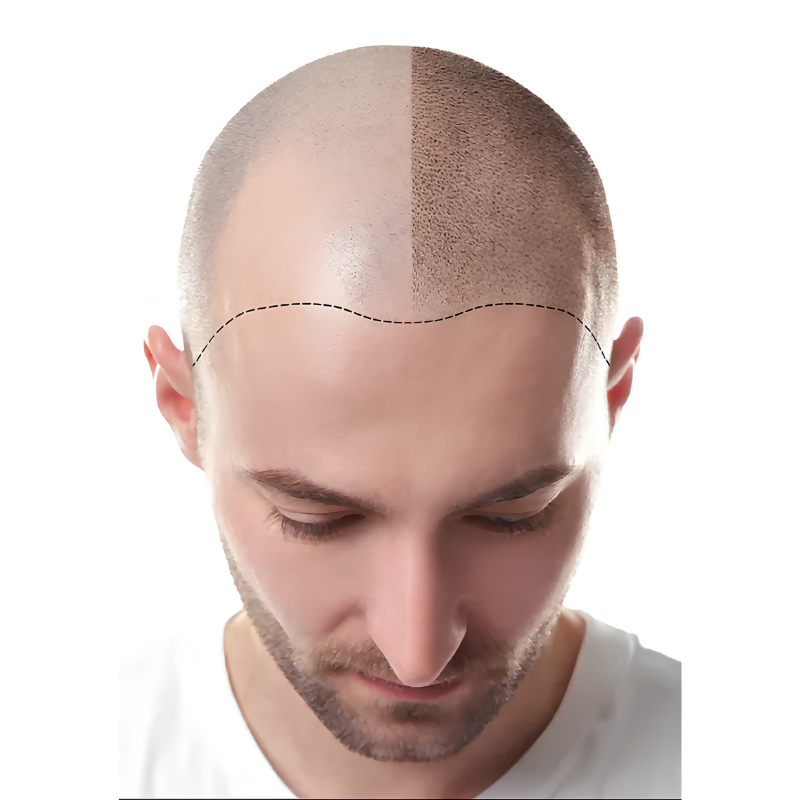 Scalp micropigmentation hair density Mumbai